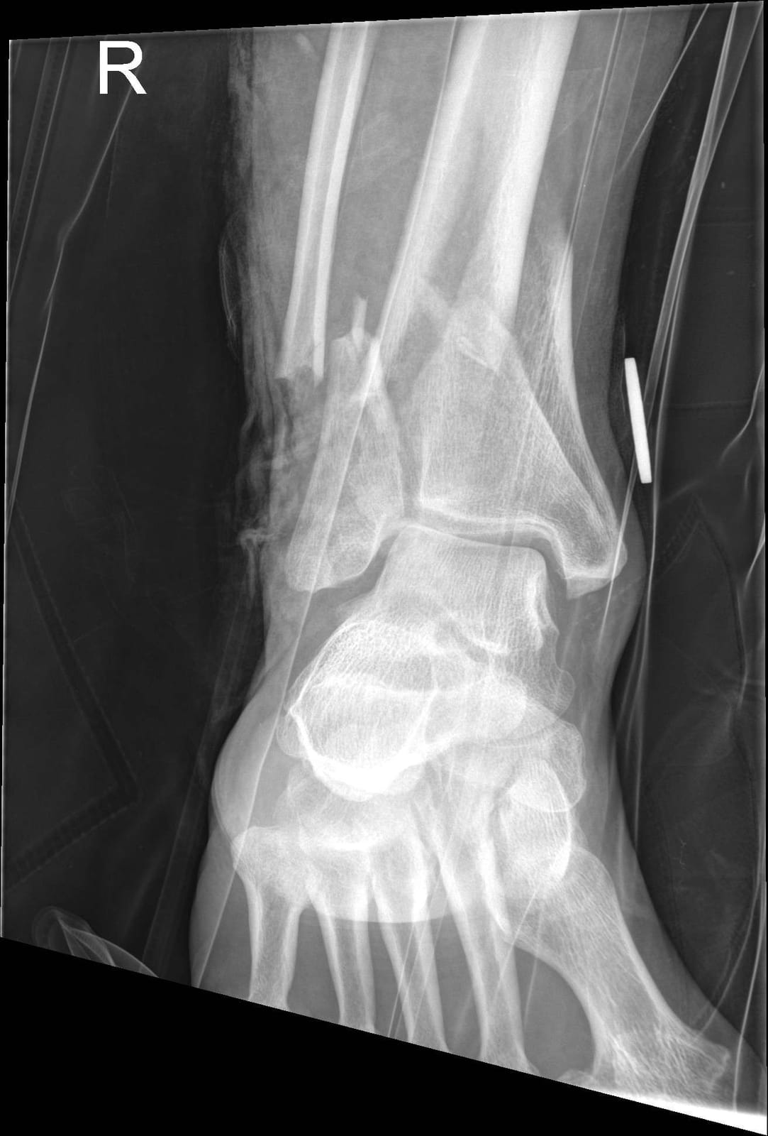 Motocross Accident